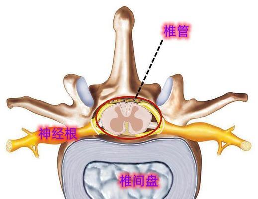 颈椎键盘突出的原因是什么？